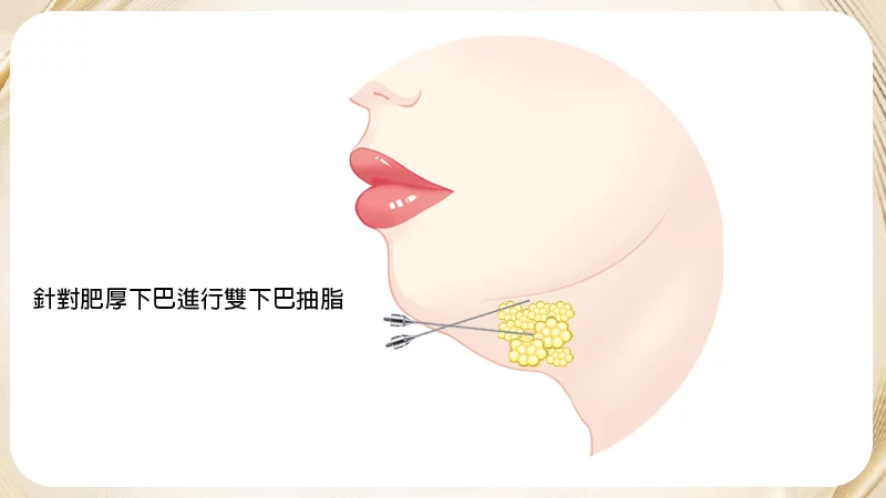 雙下巴抽脂