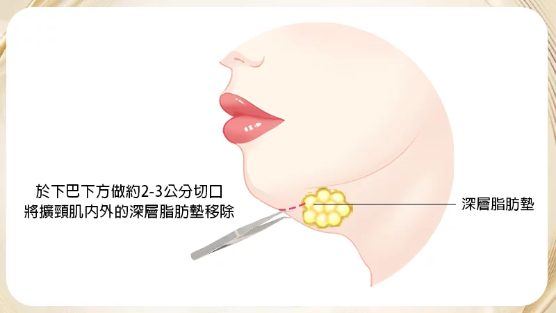 深層脂肪墊移除