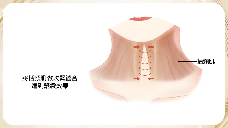 闊頸肌縫合
