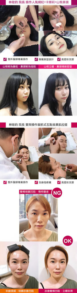 林敬鈞醫師獨創 貓爪式五點拉提法 (玻尿酸注射技術) 示意圖