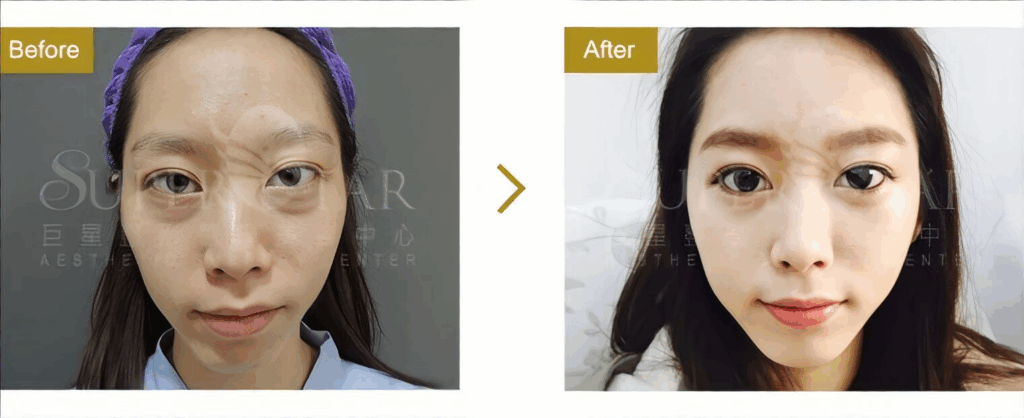 Ellanse 洢蓮絲 蘋果肌填補 與 豐頰拉提 術後效果分享 Case 4