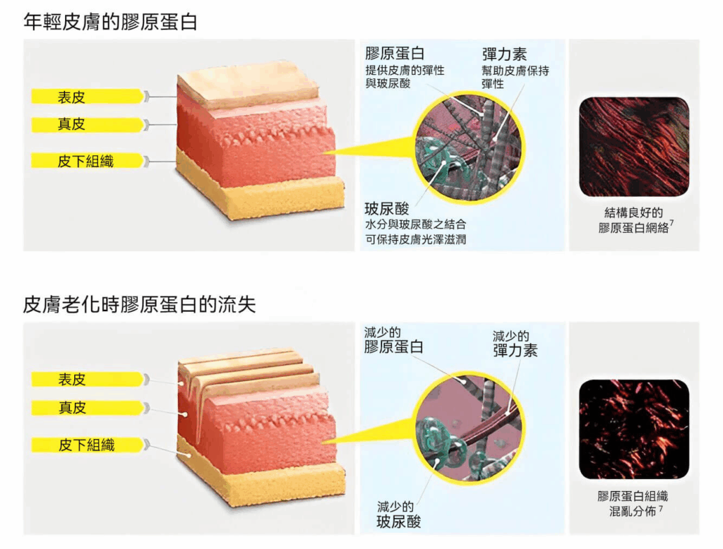 Ellanse 洢蓮絲 CMC 凝膠載體 立即填補皮膚凹陷示意圖