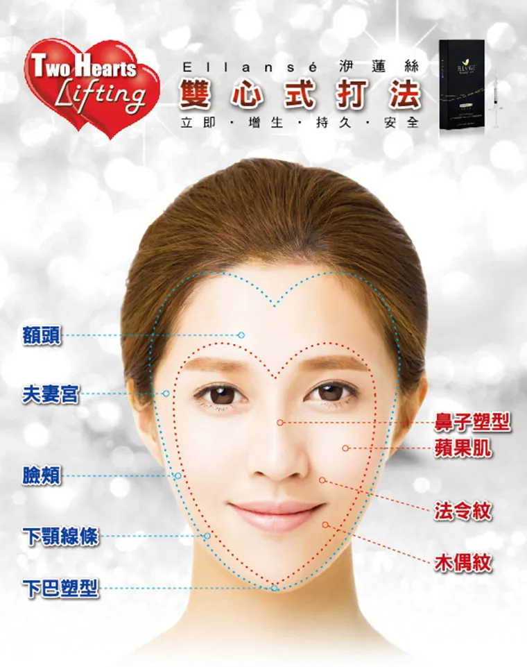 林敬鈞醫師獨創 Ellanse 洢蓮絲 雙心式打法 (Two-Heart Lifting) 示意圖