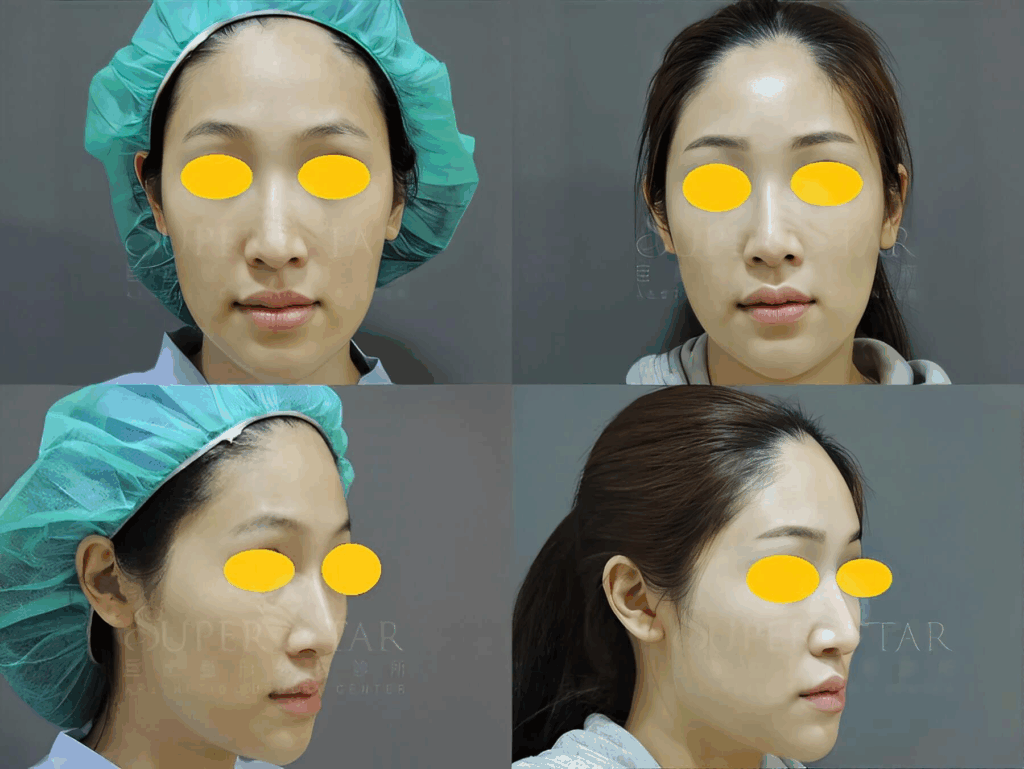 Ellanse 洢蓮絲 改善臉部凹陷 豐頰與填補夫妻宮 實際案例 Case 3