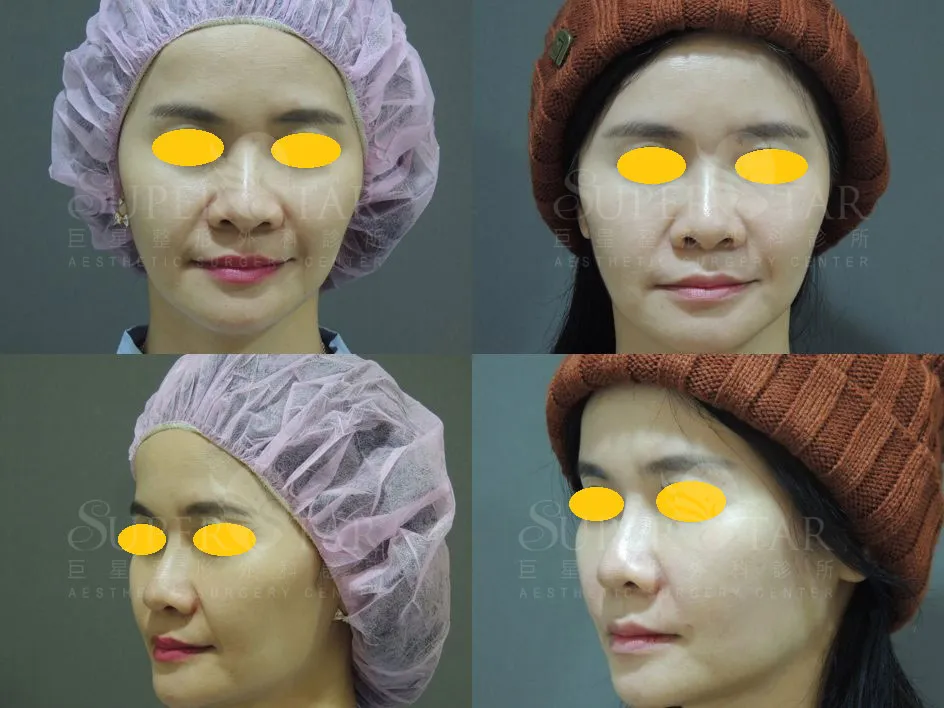 Ellanse 洢蓮絲 治療法令紋與臉頰凹陷 術前術後對比照 Case 2