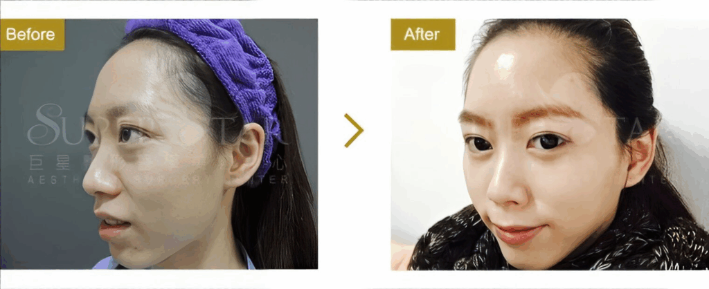 Ellanse 洢蓮絲 術前術後案例：豐額與夫妻宮填補 - 巨星醫美
