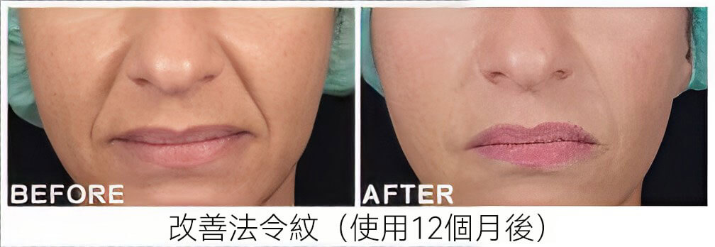 Ellanse 洢蓮絲 施打位置圖解：法令紋、木偶紋、臉頰凹陷、下巴塑形