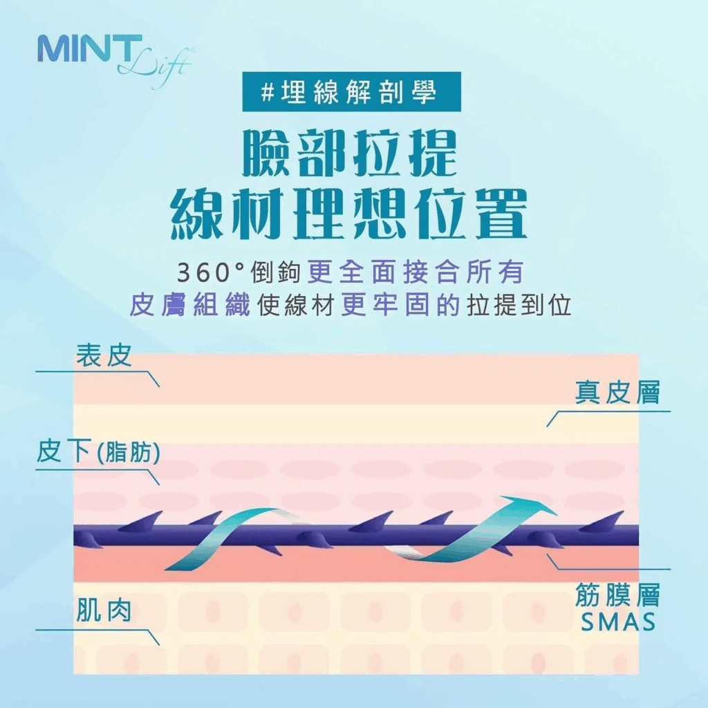 埋線拉提 深入 SMAS 筋膜層 緊緻拉提示意圖