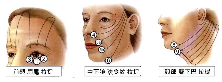 埋線拉提效果示意：改善臉部鬆弛、下垂與皺紋