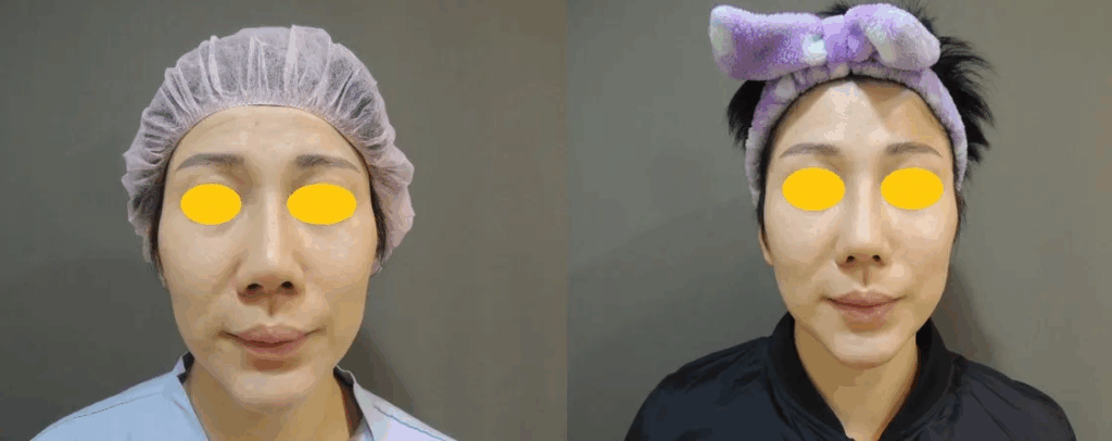 神力拉提 術前術後案例 Case：雙螺旋線雕改善嘴邊肉與V臉拉提