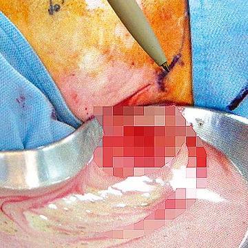 自體脂肪隆乳流巧克力膿 - 感染了怎麼辦?