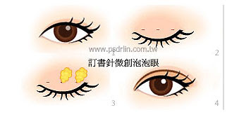 混血萌微創泡泡眼手術示意