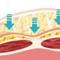 4D 威塑脂雕 4D VASER Lipo