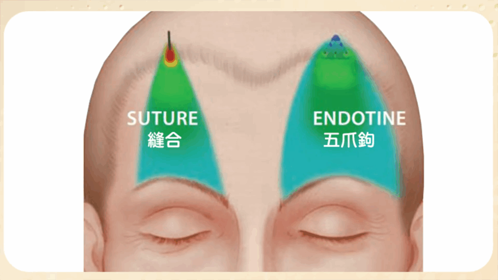 內視鏡提眉手術示意圖