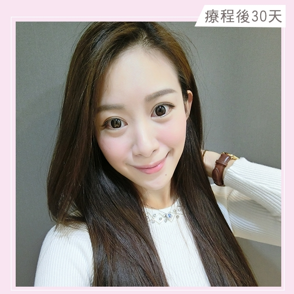 療程後30天