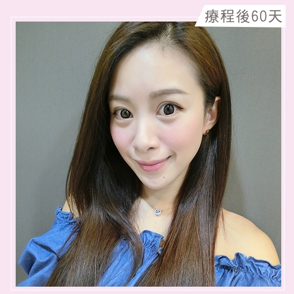 療程後60天