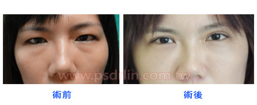 案例一：無痕複合式眼袋內開手術 + 全臉補脂