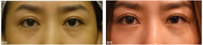 案例三：無痕複合式眼袋內開手術