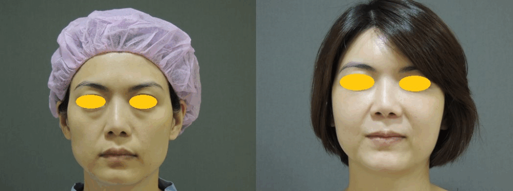 案例四：無痕複合式眼袋內開手術