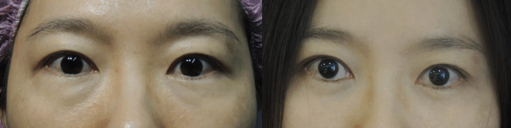 案例六：無痕複合式眼袋內開手術