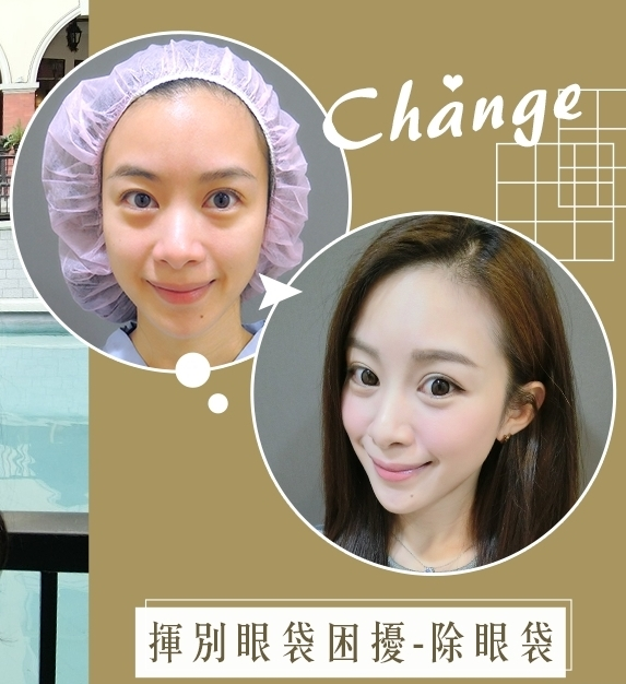揮別眼袋困擾-除眼袋