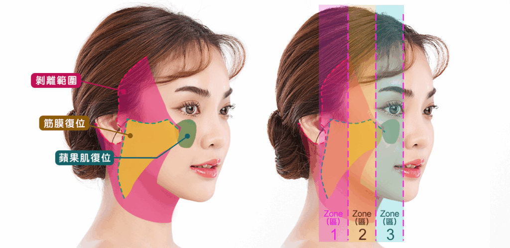 何謂全層次結構式拉皮？