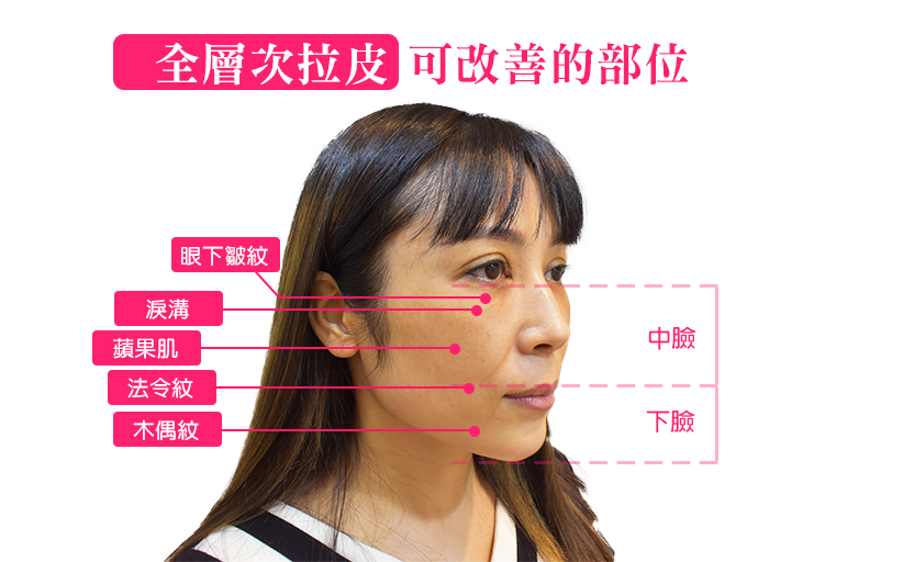 全層次結構式拉皮可改善七大部位
