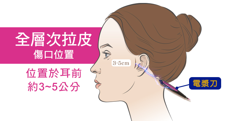 全層次拉皮切口與隱痕設計