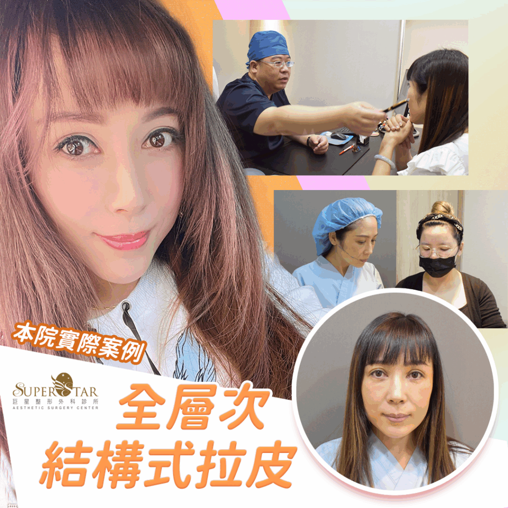 CASE 1：全層次結構式拉皮 + 愛波中臉小拉皮
