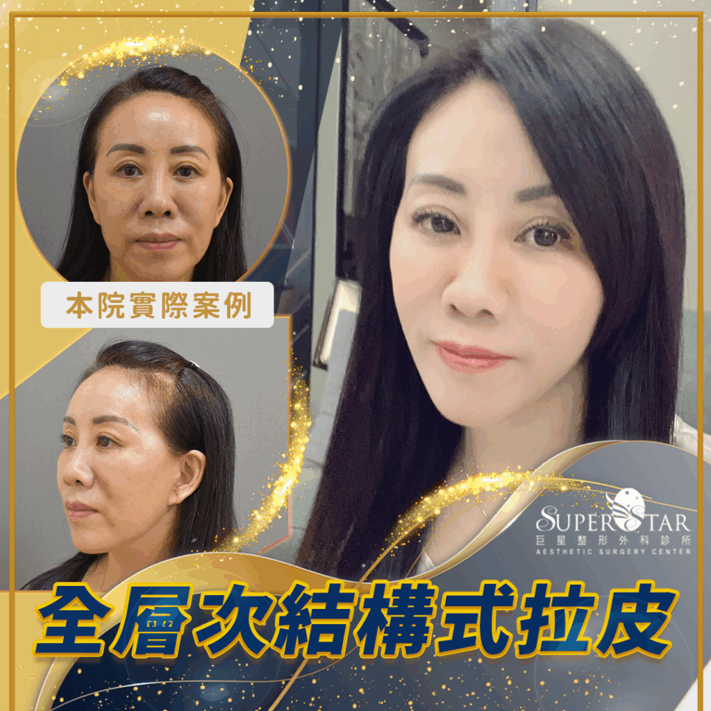 CASE 2：全層次結構式拉皮 + 愛波中臉小拉皮