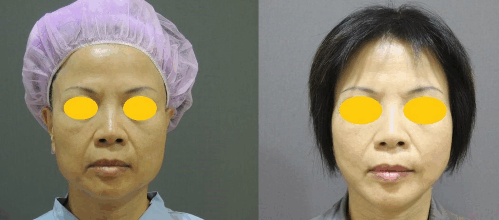 CASE 3：全層次結構式拉皮