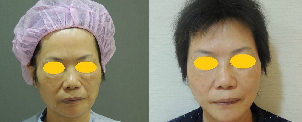 CASE 4：全層次結構式拉皮1