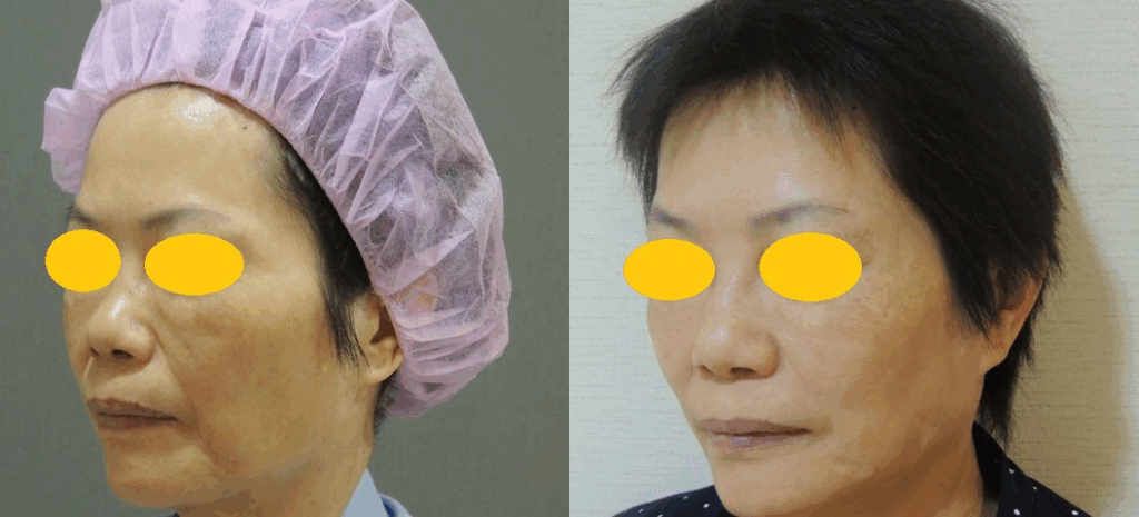 CASE 4：全層次結構式拉皮2