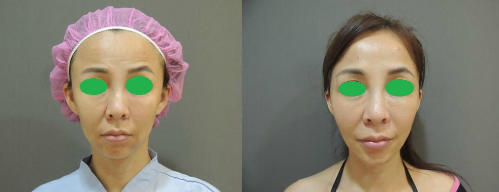 CASE 5：全層次結構式拉皮