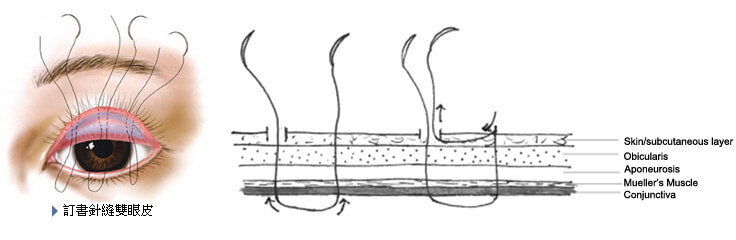 巨星整形林敬鈞醫師觀點：突破傳統的 2+1 縫法