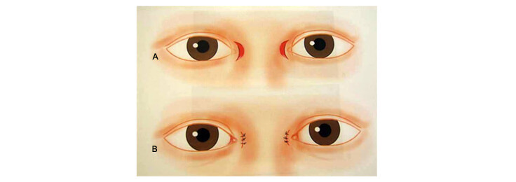 隱形開眼頭手術：放大雙眼的關鍵拼圖