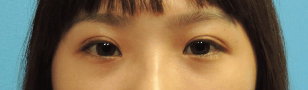 Case 8  訂書針縫雙眼皮 手術後