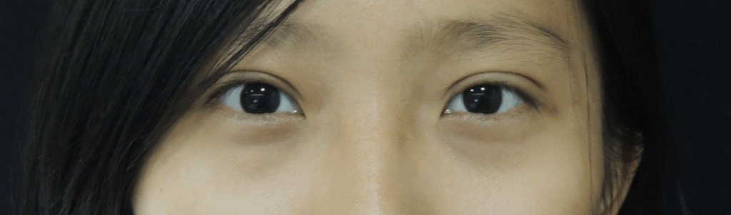 Case 10  訂書針縫雙眼皮 手術後