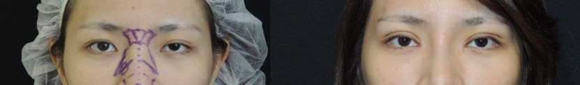 Case 11：訂書針縫雙眼皮 + 韓式隆鼻前後