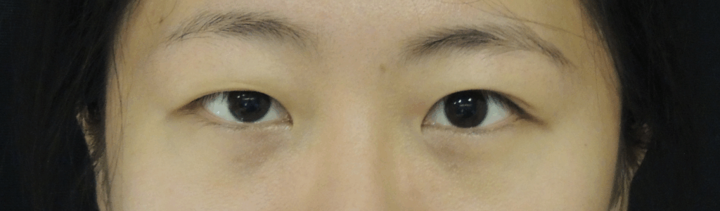 Case 14：訂書針微創泡泡眼 (縫雙眼皮 + 微小切口抽脂)術前