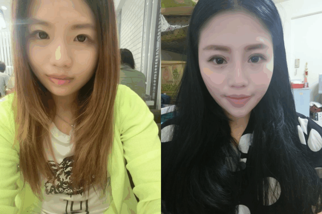 Case 21：訂書針縫雙眼皮 + 微小切口抽泡泡眼 + 開眼頭 + 韓式隆鼻