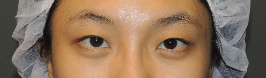 Case 23：訂書針縫雙眼皮 + 開眼頭術前