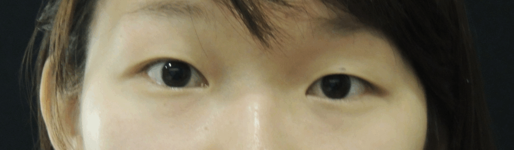 Case 25：訂書針縫雙眼皮 + 開眼頭術前