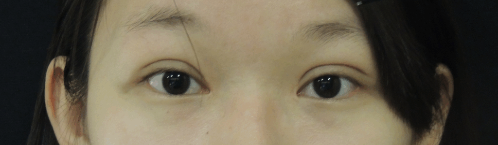 Case 25：訂書針縫雙眼皮 + 開眼頭術後