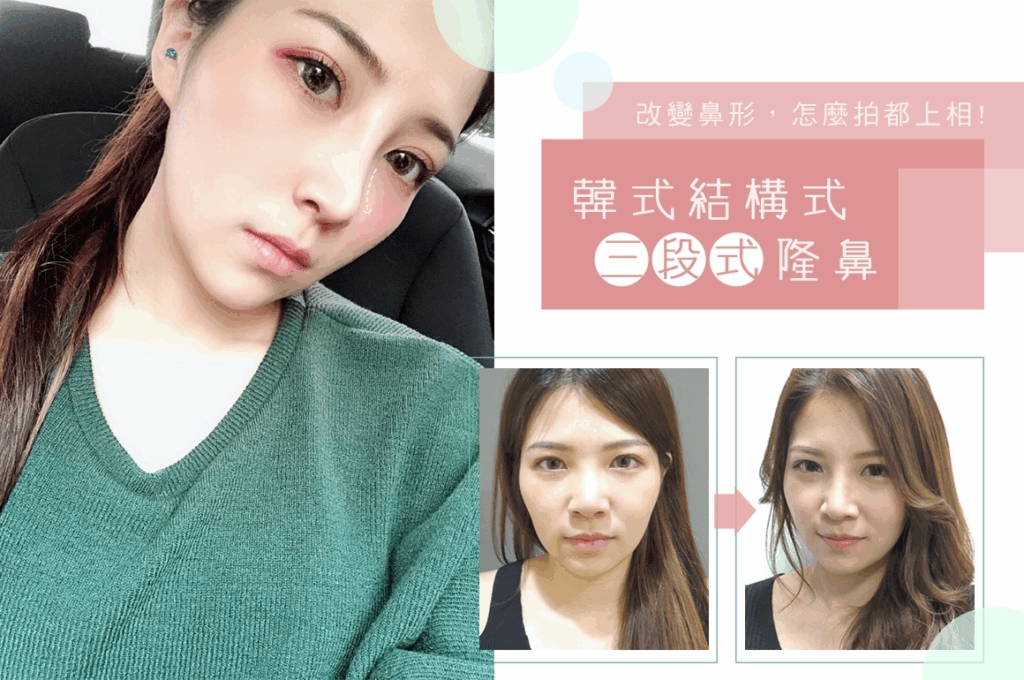 Case1 複合式隆鼻, 三段式隆鼻 (Pureform+自體肋骨)－進階版韓式隆鼻