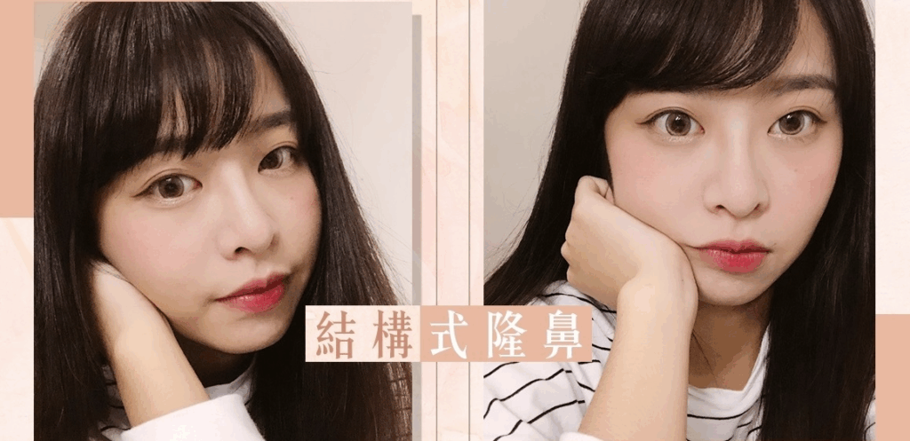 Case2 三段式韓式隆鼻 – 複合式隆鼻 (Goretex+自體肋骨)1