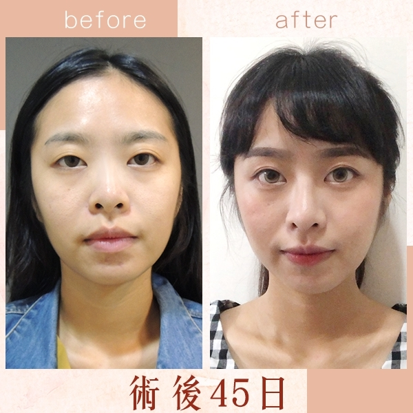 Case2 三段式韓式隆鼻 – 複合式隆鼻 (Goretex+自體肋骨)術後45天