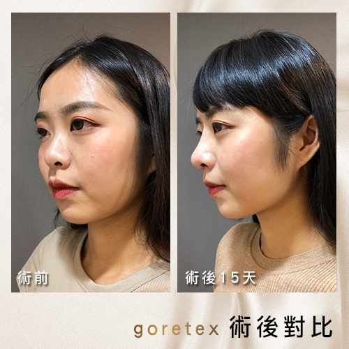 Case2 三段式韓式隆鼻 – 複合式隆鼻 (Goretex+自體肋骨)術後15天
