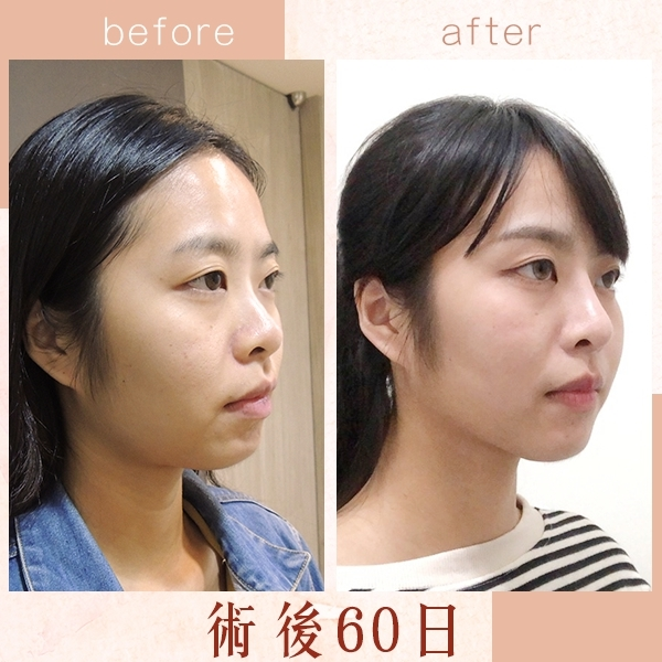 Case2 三段式韓式隆鼻 – 複合式隆鼻 (Goretex+自體肋骨)術後60天