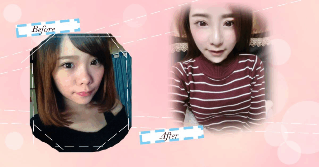 Case3 韓式結構式隆鼻